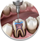 Root Canal Therapy