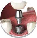 Crowns, Bridges & Implants