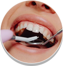 Full-Mouth Rehabilitation