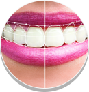 Smile Designing & Veneers